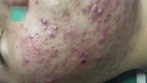 #534 Удаление акне. Экстракция комедонов. Подкожные прыщи. Чистка от черных точек