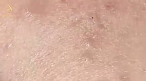 Лечение акне от Лоан Нгуен