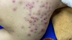 Удаление прыщей и комедонов на спине