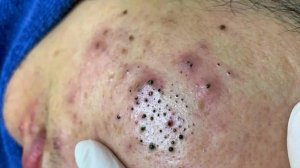 Извлечение черных точек в салоне Тody Spa
