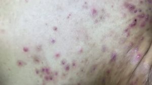 Чистка кожи от комедонов со спины. Механический способ