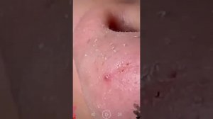 Удаление черных точек пинцетом