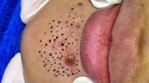 Удаление черных точек в Sac Dep Spa