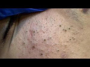 Прощай, черные точки — ПОЛНОЕ РУКОВОДСТВО | Натуральные средства и глубокое очищение