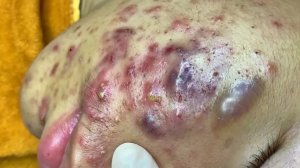 Удаление черных точек в Sac Dep Spa