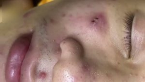 Удаление стойких комедонов в СПА-салоне