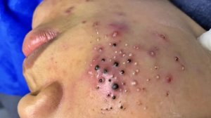Удаление черных точек в Sac Dep Spa
