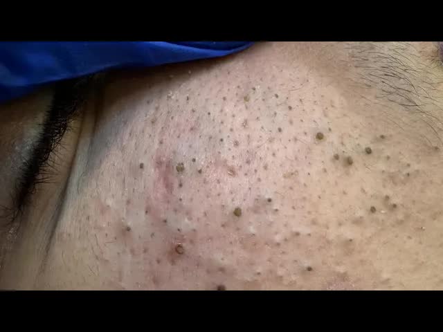 Уход за кожей | Удаление чёрных точек и прыщей Глубокое очищение лица смотреть онлайн
