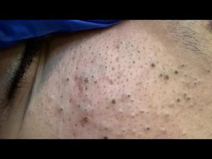 Уход за кожей | Удаление чёрных точек и прыщей Глубокое очищение лица