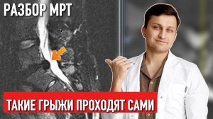 Вот как выглядит большая грыжа, которая пройдет без операции