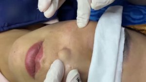 Глубокое очищение пор от прыщей