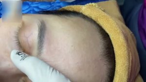 Asmr. Избавляемся от прыщей, комедонов и сальных пробок.