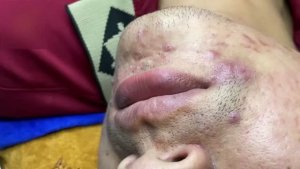 Очищение кожи от акне и сальных пробок