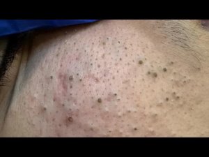 Лучшие методы глубокого очищения пор от чёрных точек — Уход за кожей