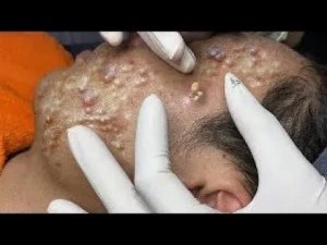 Экстремальное удаление черных точек ☺️ Удовольствие и релакс