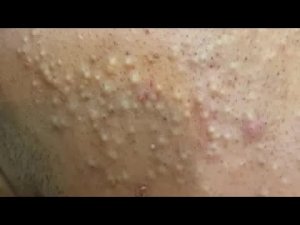 ASMR | Удаление черных точек и лечение прыщей | Уход за кожей
