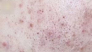Профессиональная чистка кожи от акне