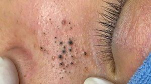 Удаление черных точек в Sac Dep Spa