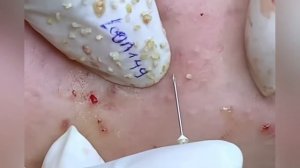 Выдавливание прыщей, угрей, черных точек и камедонов #638