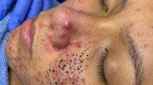 Удаление черных точек в спа-салоне Sac Dep