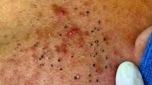 Удаление черных точек в салоне Sac Dep Spa