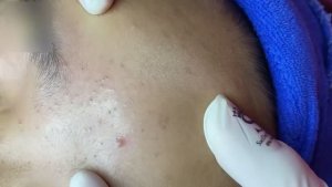 Чистка черных точек и закрытых комедонов