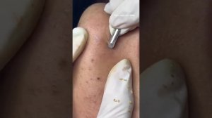 Удаление закрытых комедонов 🧹