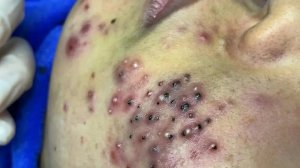 Удаление черных точек в Sac Dep Spa