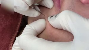 Удаление комедонов с кожи лица