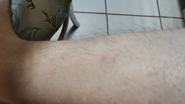 Что делать если вас укусил вампир 🧛♂️ или комар 🆘 смотреть онлайн