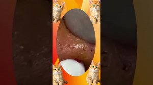 Удаление чёрных точек #663 | Лечение акне и очень удовлетворительное выдавливание прыщей
