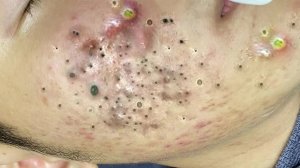 Экстремальное удаление черных точек 🎯 Расслабление и удовлетворение
