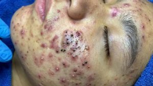 Удаление черных точек в спа