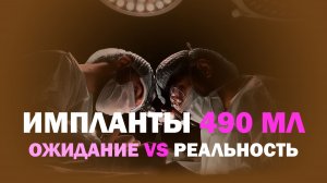 Увеличение груди имплантами 490 мл: почему результат выглядит естественно