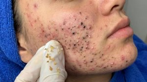 Удаление черных точек в Sac Dep Spa