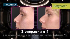 Четверо детей, липофилинг груди и ринопластика | Результат спустя почти 2 года