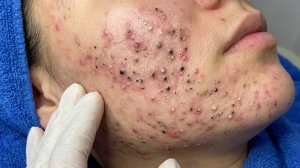 Удаление черных точек в Sac Dep Spa