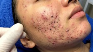 Удаление черных точек в Sac Dep Spa