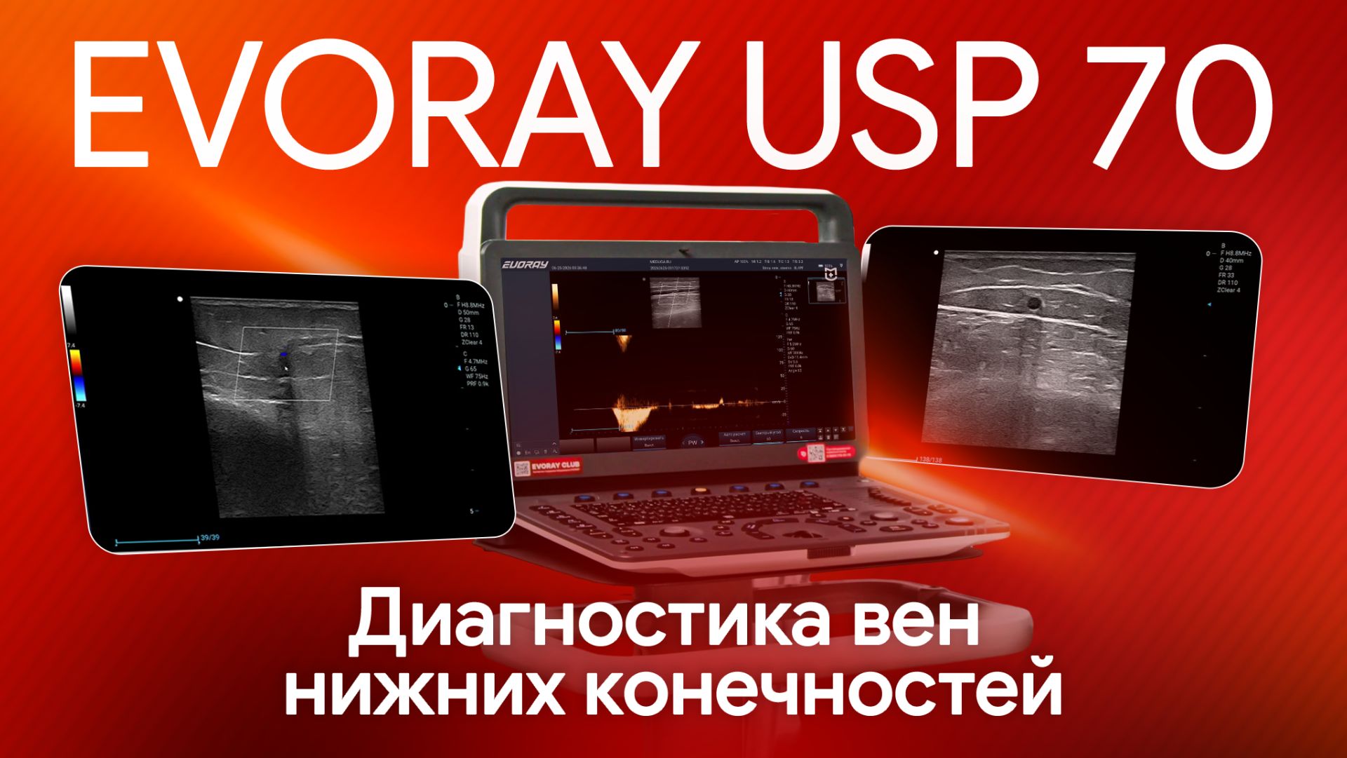 УЗИ вен нижних конечностей на EVORAY USP 70: мастер-класс по полному протоколу смотреть онлайн