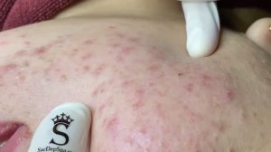 Удаление механически угрей и крупных прыщей