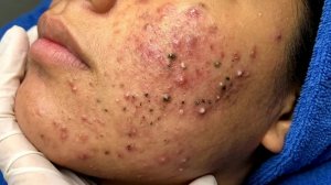 Удаление чёрных точек в Sac Dep Spa