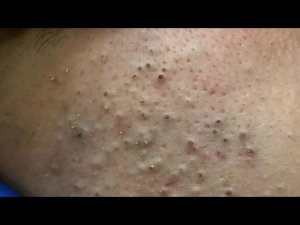 Глубокое очищение пор от черных точек | Преображение кожи