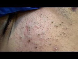Глубокое очищение от акне | ASMR — Чёрные точки и прыщи