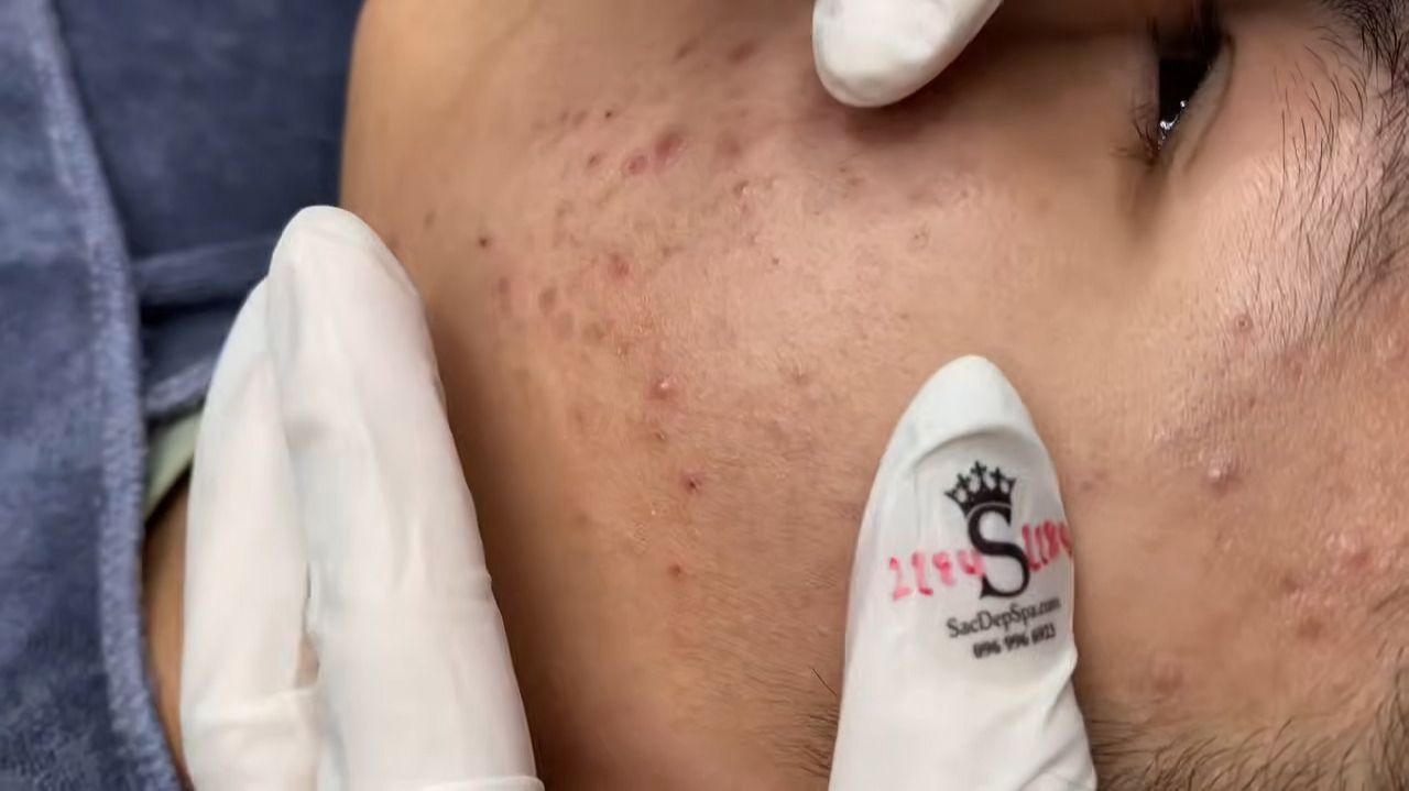 330 • Acne Collection • АСМР • Relax Spa