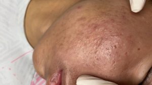 347 • Acne collection • АСМР • Relax Spa
