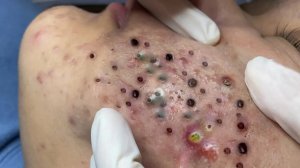 Экстремальное удаление черных точек | Удовольствие и релакс