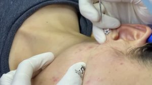 Удаление стойких комедонов в салоне