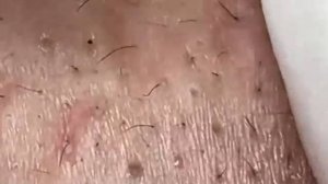 Экстремальное удаление черных точек. Удовлетворяющее расслабление