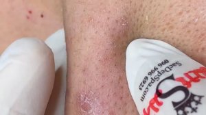 348 • Acne collection • АСМР • Relax Spa