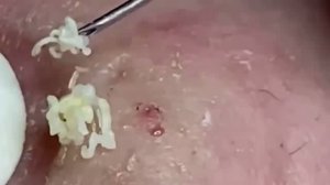#2 Чистка лица от прыщей и черных точек